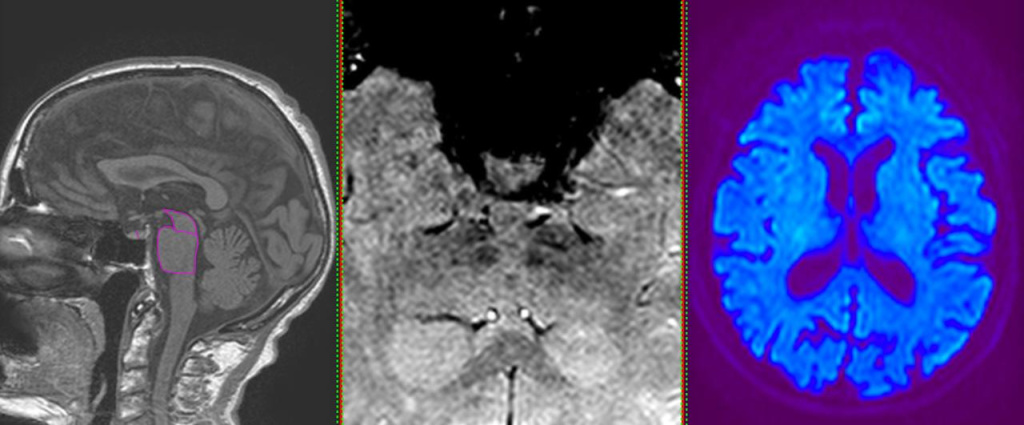 МРТ при болезни Паркинсона mrt1.jpg